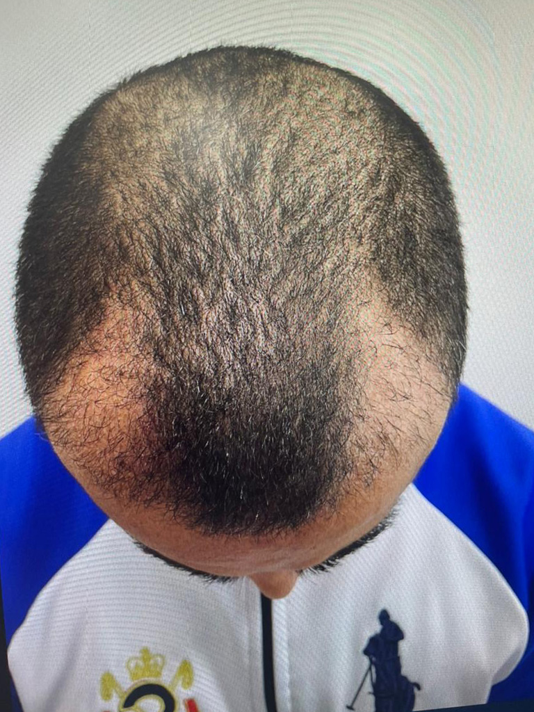 Antes